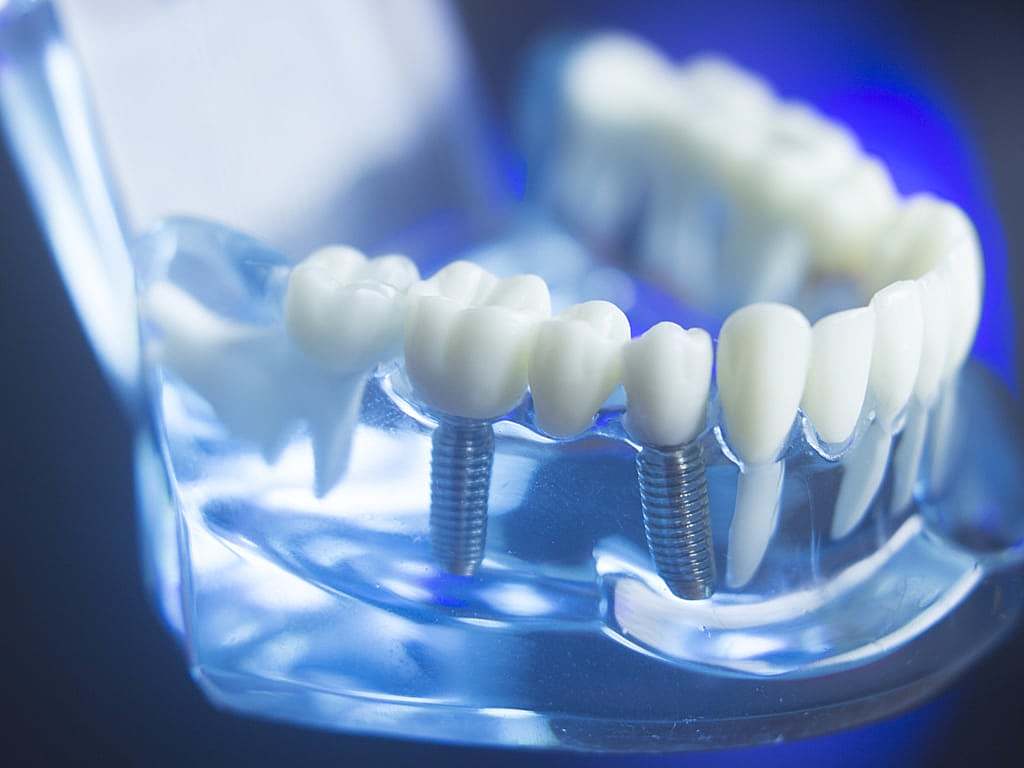 Implant dentaire : Une dent particulière ?