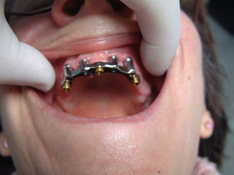 Implant dentaire : Une dent particulière ?