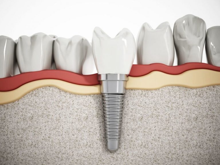 Centre médical dentaire : quels sont les risques des problèmes dentaires ?