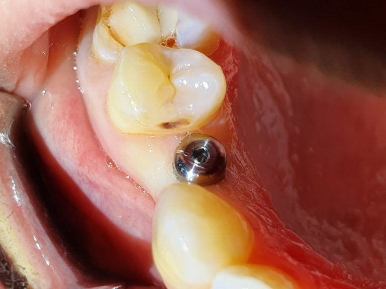 Implant dentaire : quel peut être la durée de vie de cette pièce ?