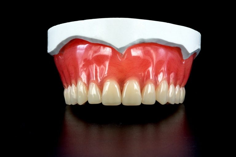 Prothèse dentaire : quels sont les différents types ?
